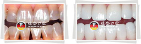 四环素牙美白前后