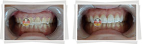 黄牙美白前后