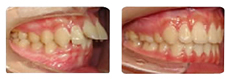 龅牙英式四维矫正案例