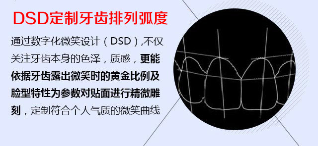 DSD定制牙齿排列弧度